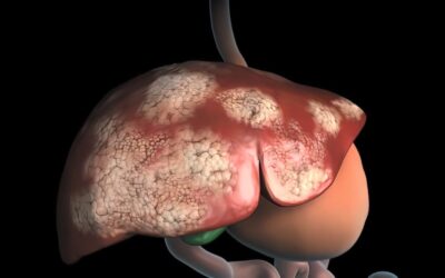 New Combination of Anti-CXCR4 and Anti-PD1 Therapy Shows Promise for Liver Cancer Treatment