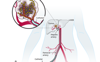 TACE-Based Treatment Combinations Effective Against Intermediate-Stage Liver Cancer